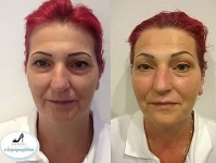 Feszes, üde és fiatalos arcbőr egy hatékony kezeléssel: Ultima Hifu teljes arcfiatalítás XI. kerület