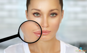 6 alkalmas dióda lézeres szőrtelenítés - felső ajak (bajusz) vagy áll területen