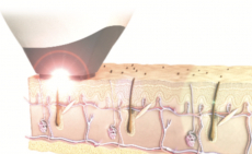 6 alkalmas dióda lézeres szőrtelenítés bikini vonalra. Légy mindig kész és önbizalommal teli!